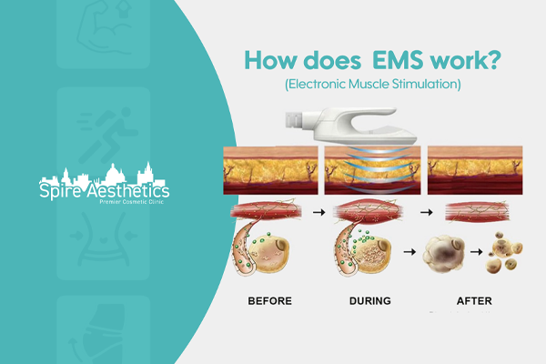 EMS treatment for post pregnancy weight loss treatment Keighley