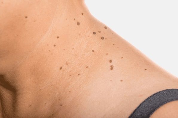 Are you looking for easy skin tag removal Keighley - then contact Spire today!