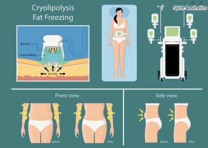 Image of diet and fat freezing combined for best results for Spire Aesthetics Keighley