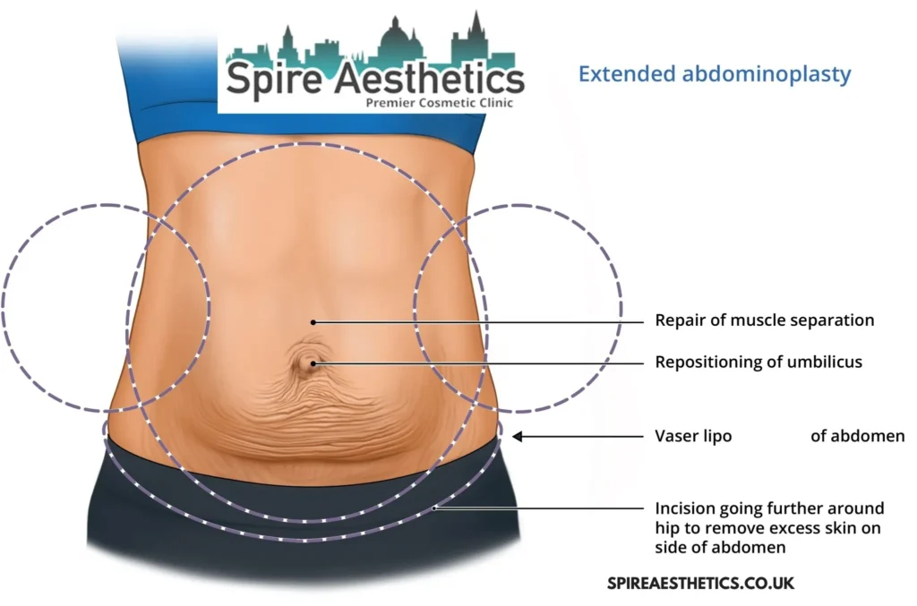 Understanding Loose Skin After Gastric Band Keighley Surgery and HIFU Treatment