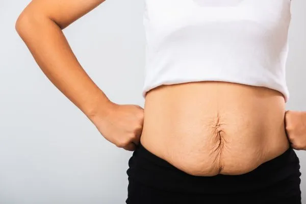 Image of a woman's stomach after weight loss with sagging skin following a gastric band Keighley