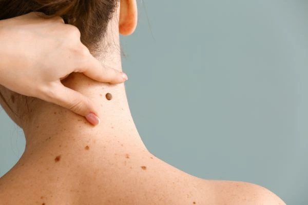 skin blemish removal Keighley treatment
