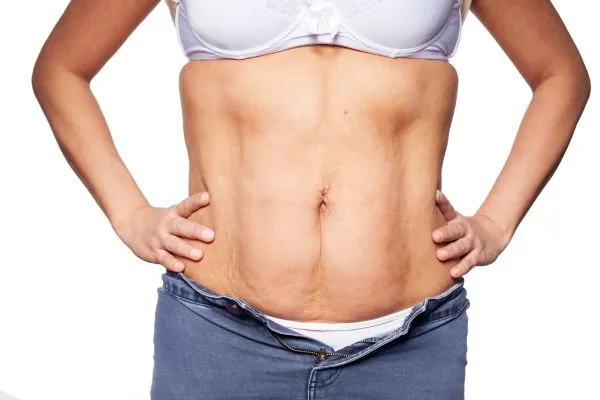 sagging skin on woman's stomach after weight loss injections Keighley
