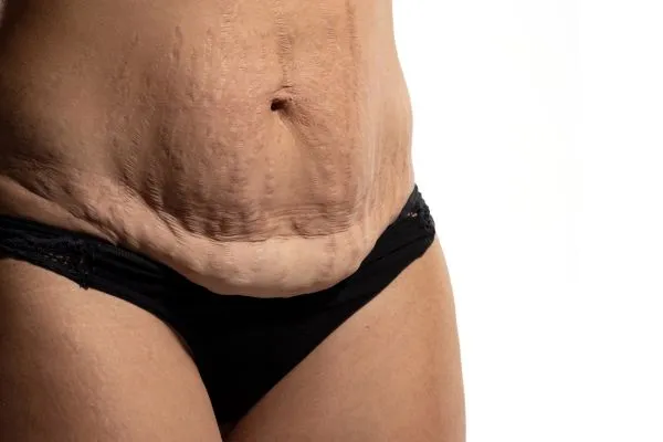 Image of womans stomach after weight loss injections Keighley showing saggy skin